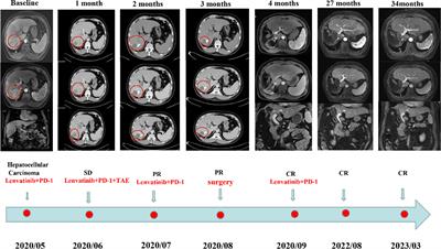 PD-1 combined with lenvatinib and TACE for the transformational treatment of hepatocellular carcinoma combined with portal vein tumor thrombus: a case report and literature review